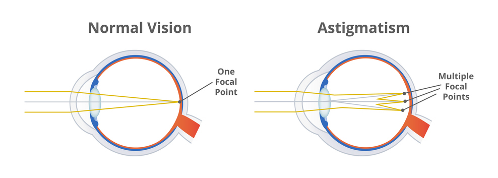 Astigmatism, refractive or refraction error. Eye disorder, eye does not focus light evenly on the retina. Blurry, blurred, or distorted vision. The illustration is isolated on a white background.