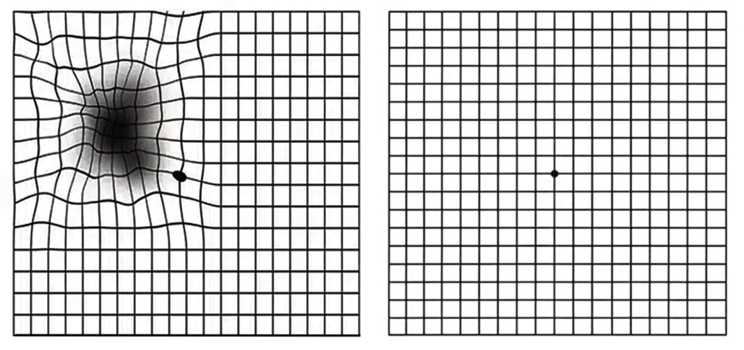 An Amsler grid showing distortion and an example without distortion.