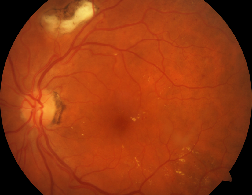 OCT of Diabetic Eye Disease with Macular Edema