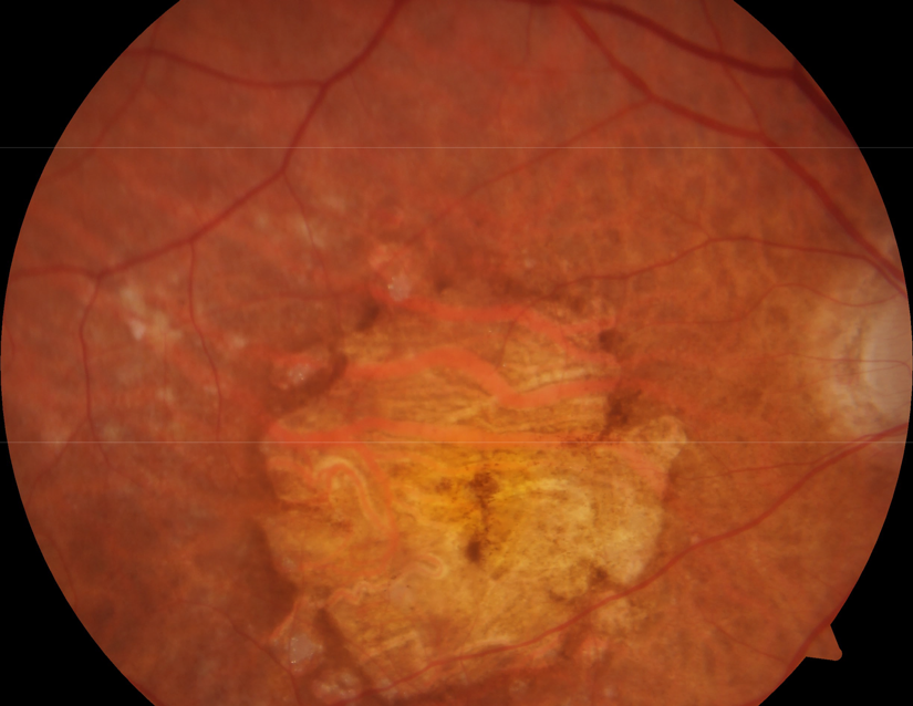 Color Fundus photo of Age-Related Macular Degeneration with Geographic Atrophy