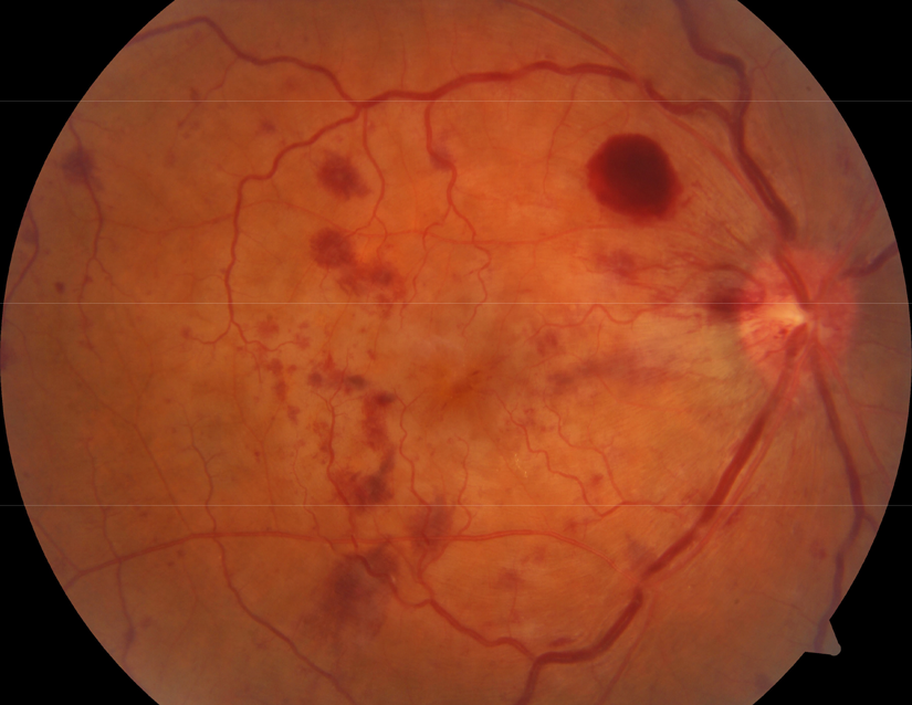 Retinal photograph of human eye with retinal vein occlusion, taken using professional clinical diagnostic equipment.