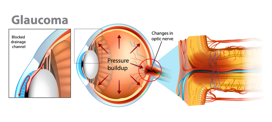 Illustration of an eye ball and optic nerve anatomy explaining the physical manifestation of glaucoma