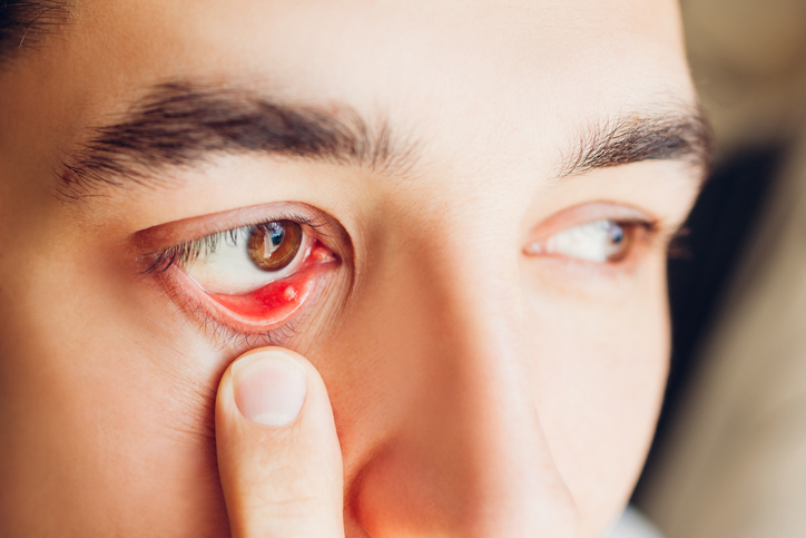 Infected stye barley purulent eye. Man pulls down lower eyelid showing inflammation pus of eyelash hair bag caused by Staphylococcus aureus. Meibomite. Health care